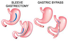 METABOLIC SURGERY