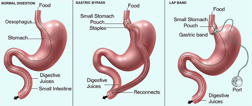 BARIATRIC SURGERY