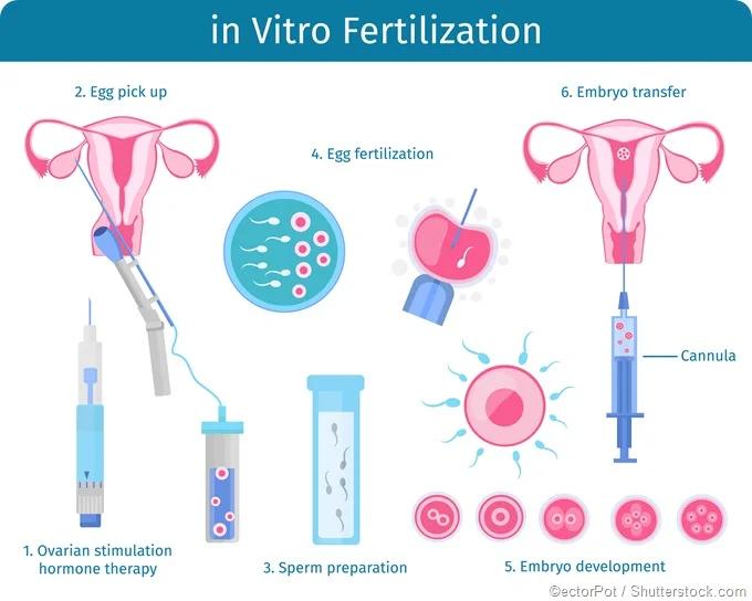 INFERTILITY AND INVITRO FERTILIZATION