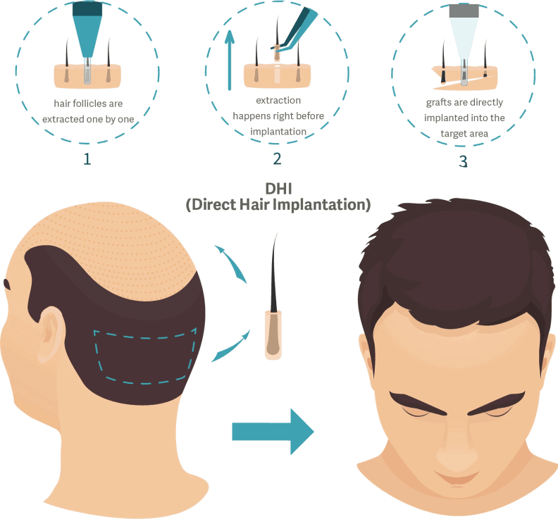 HAIR TRANSPLANTATION